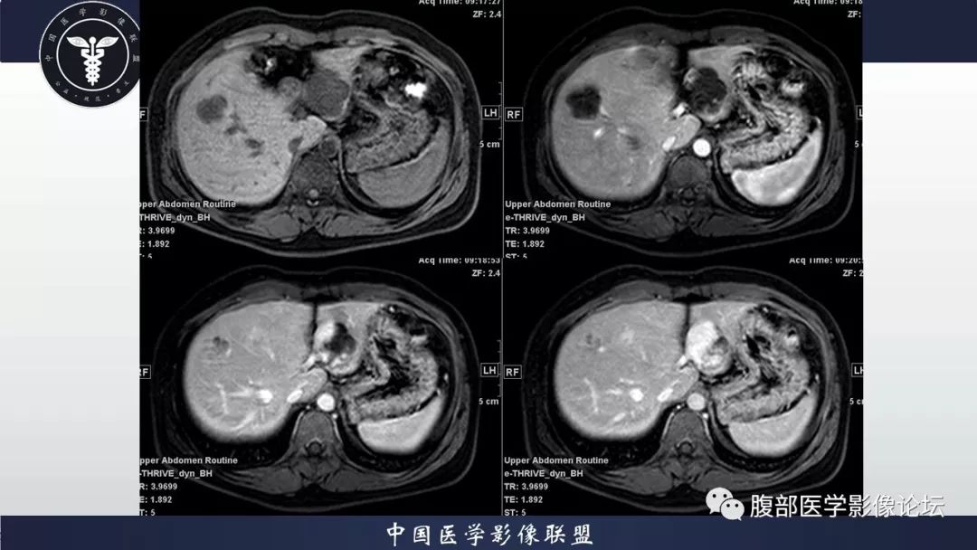【病例】十二指肠水平部肠系膜纤维瘤病1例CT及MR