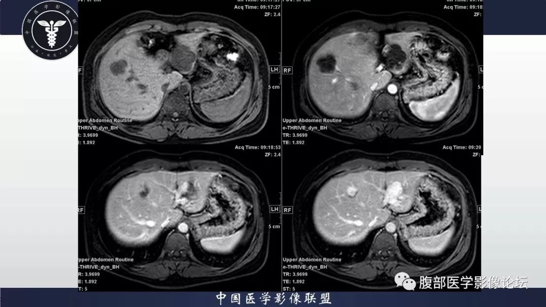 【病例】十二指肠水平部肠系膜纤维瘤病1例CT及MR