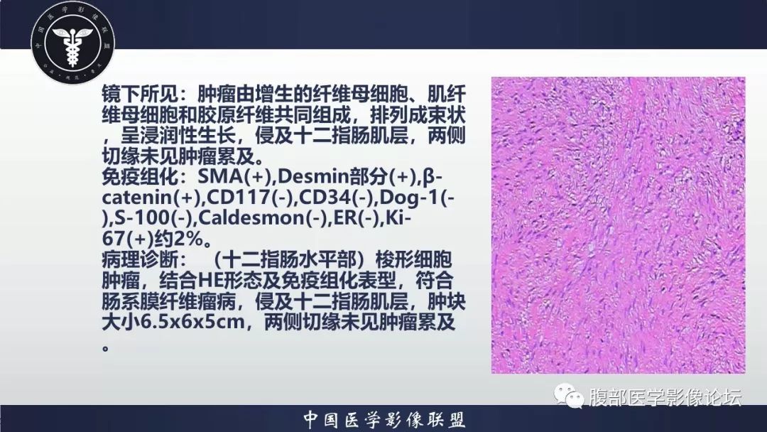 【病例】十二指肠水平部肠系膜纤维瘤病1例CT及MR