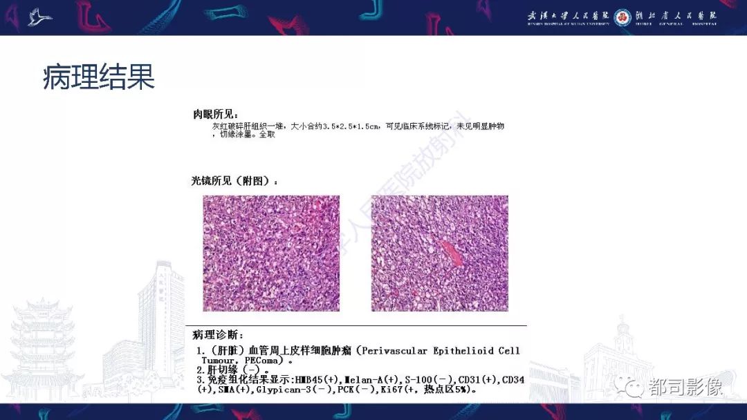 【PPT】肝脏血管周上皮样细胞肿瘤影像诊断