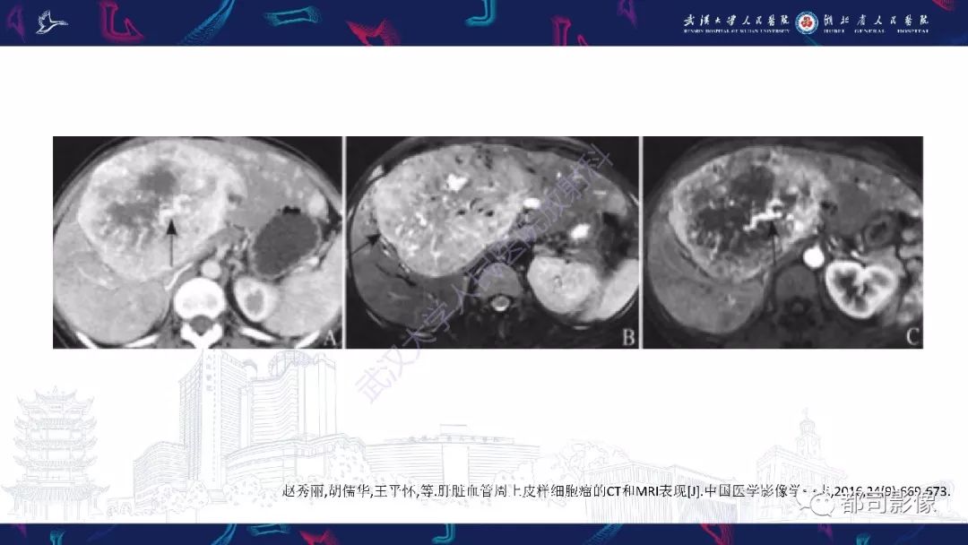 【PPT】肝脏血管周上皮样细胞肿瘤影像诊断