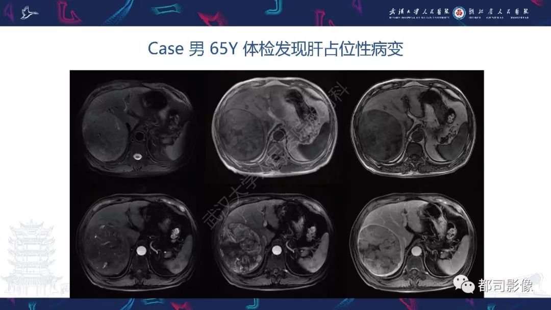 【PPT】肝脏血管周上皮样细胞肿瘤影像诊断