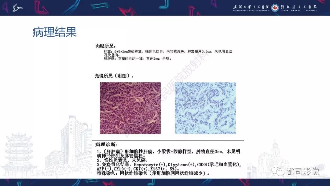【PPT】肝脏血管周上皮样细胞肿瘤影像诊断