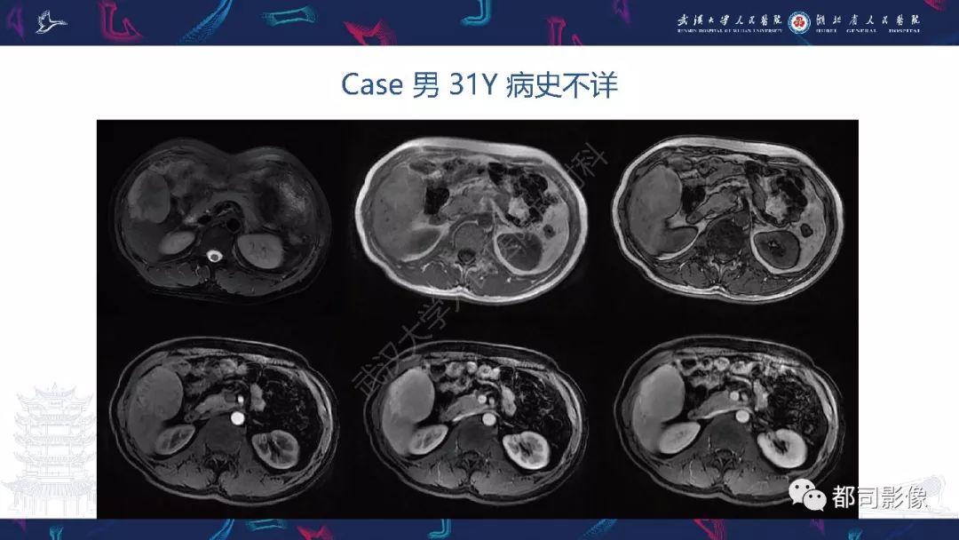【PPT】肝脏血管周上皮样细胞肿瘤影像诊断