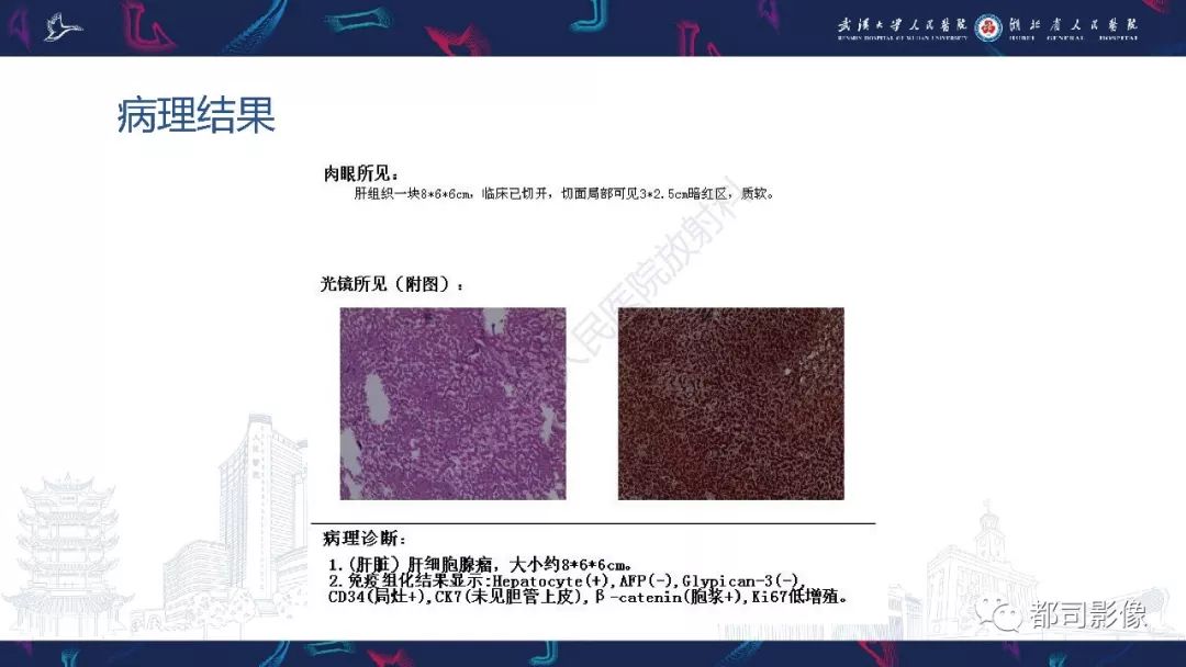 【PPT】肝脏血管周上皮样细胞肿瘤影像诊断