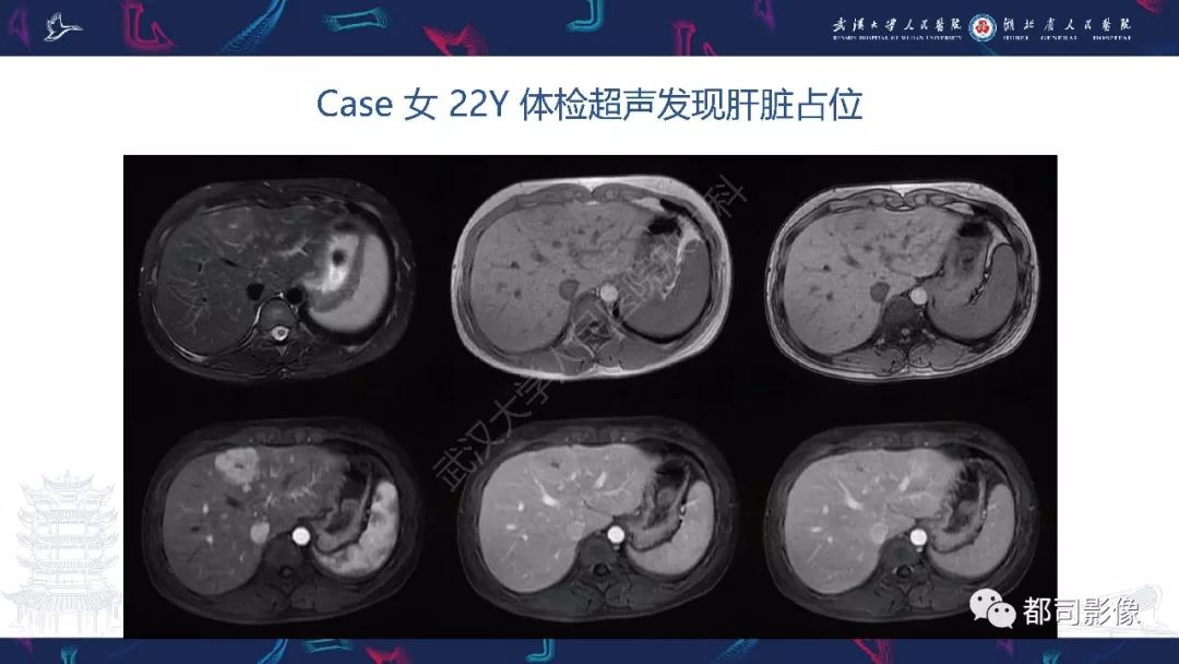 【PPT】肝脏血管周上皮样细胞肿瘤影像诊断