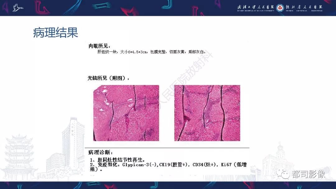 【PPT】肝脏血管周上皮样细胞肿瘤影像诊断
