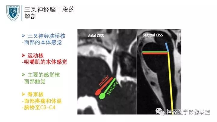 【PPT】三叉神经痛的影像学评价：分段法