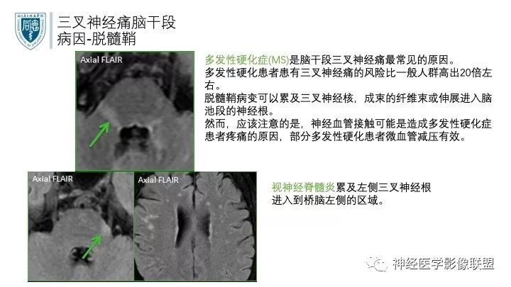 【PPT】三叉神经痛的影像学评价：分段法