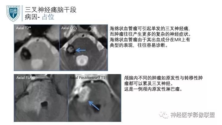 【PPT】三叉神经痛的影像学评价：分段法