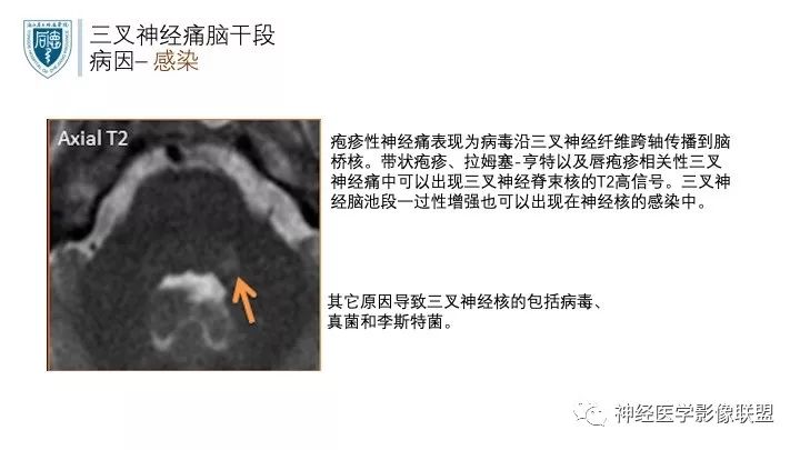 【PPT】三叉神经痛的影像学评价：分段法