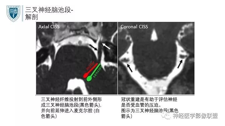 【PPT】三叉神经痛的影像学评价：分段法