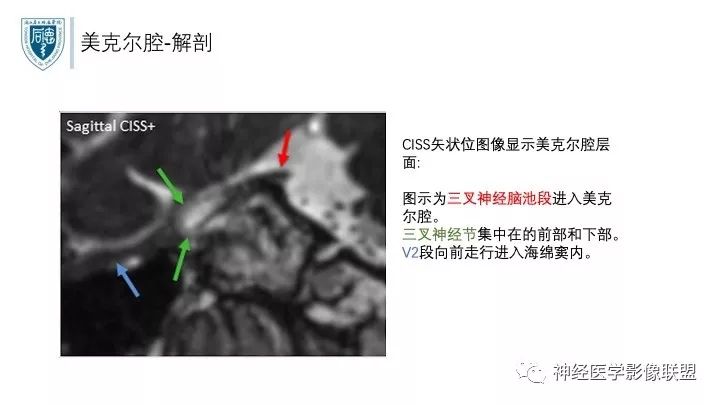 【PPT】三叉神经痛的影像学评价：分段法