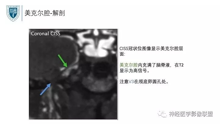 【PPT】三叉神经痛的影像学评价：分段法