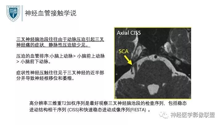 【PPT】三叉神经痛的影像学评价：分段法