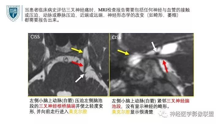 【PPT】三叉神经痛的影像学评价：分段法