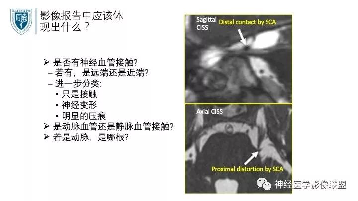 【PPT】三叉神经痛的影像学评价：分段法