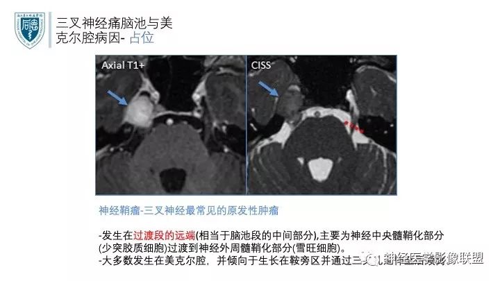 【PPT】三叉神经痛的影像学评价：分段法