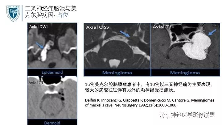 【PPT】三叉神经痛的影像学评价：分段法