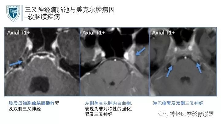 【PPT】三叉神经痛的影像学评价：分段法