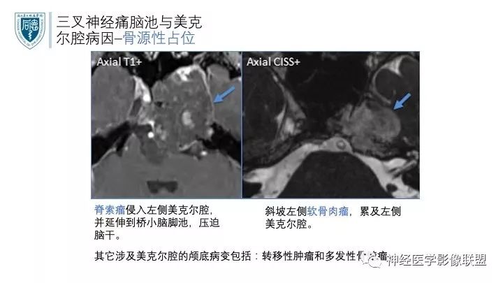 【PPT】三叉神经痛的影像学评价：分段法