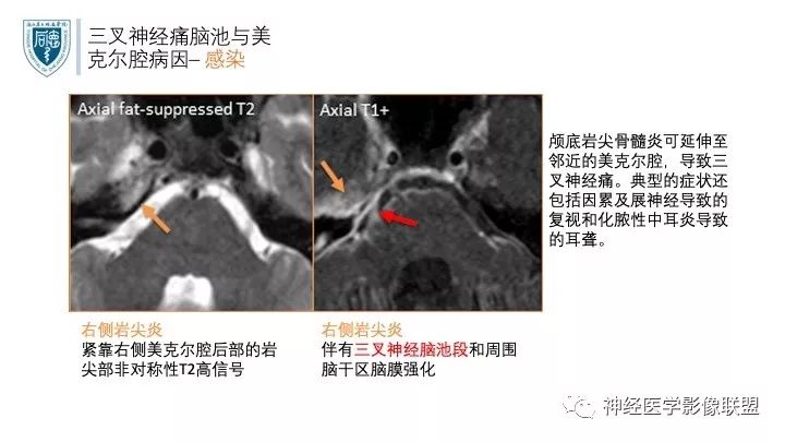 【PPT】三叉神经痛的影像学评价：分段法