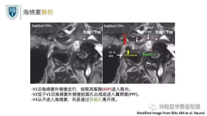 【PPT】三叉神经痛的影像学评价：分段法