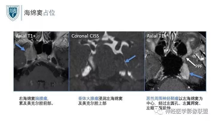 【PPT】三叉神经痛的影像学评价：分段法