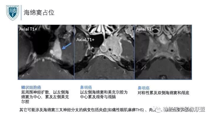 【PPT】三叉神经痛的影像学评价：分段法