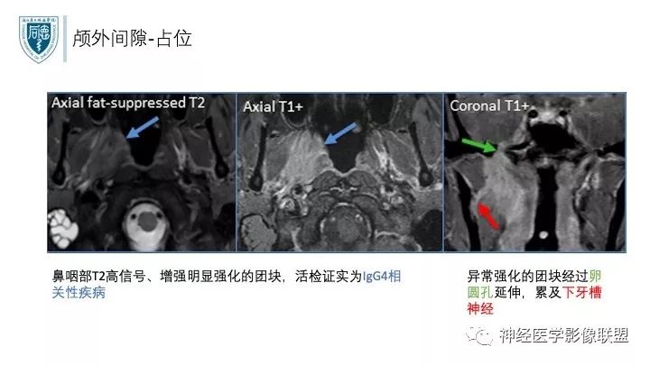 【PPT】三叉神经痛的影像学评价：分段法