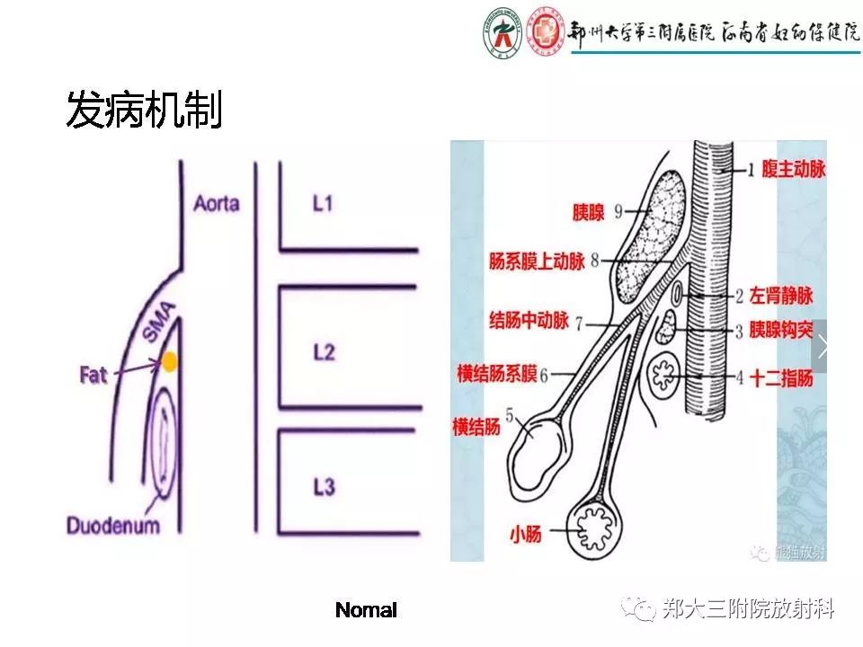 【PPT】肠系膜上动脉综合征​