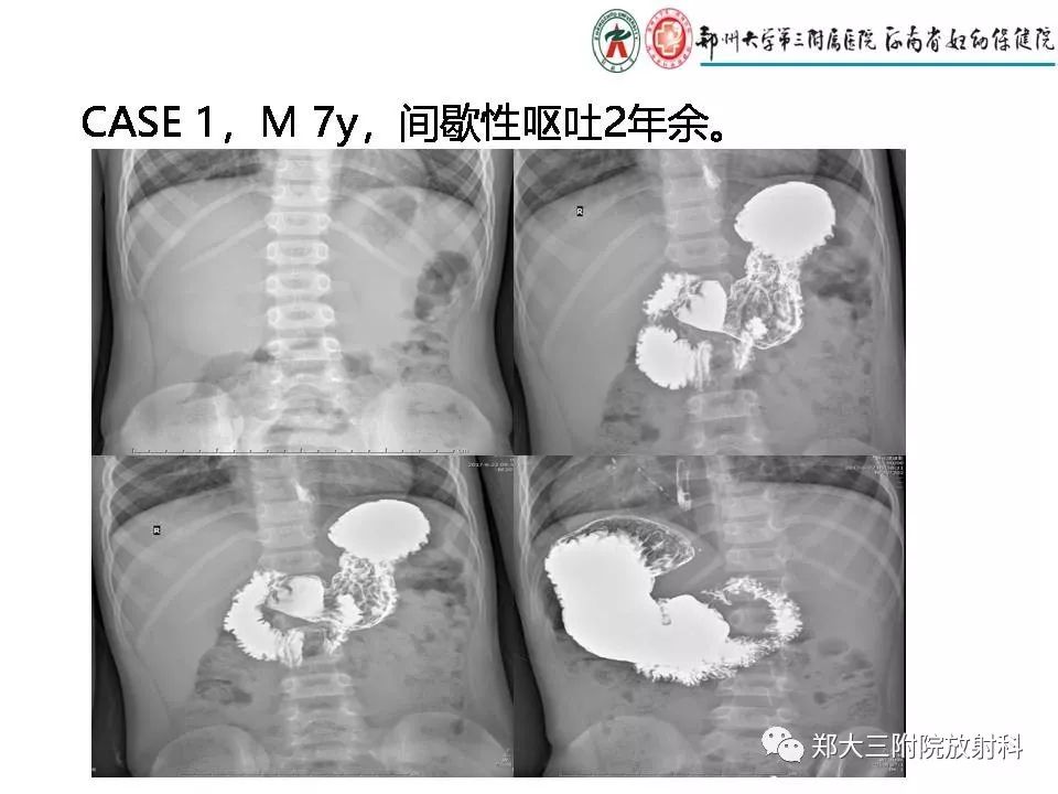 【PPT】肠系膜上动脉综合征​