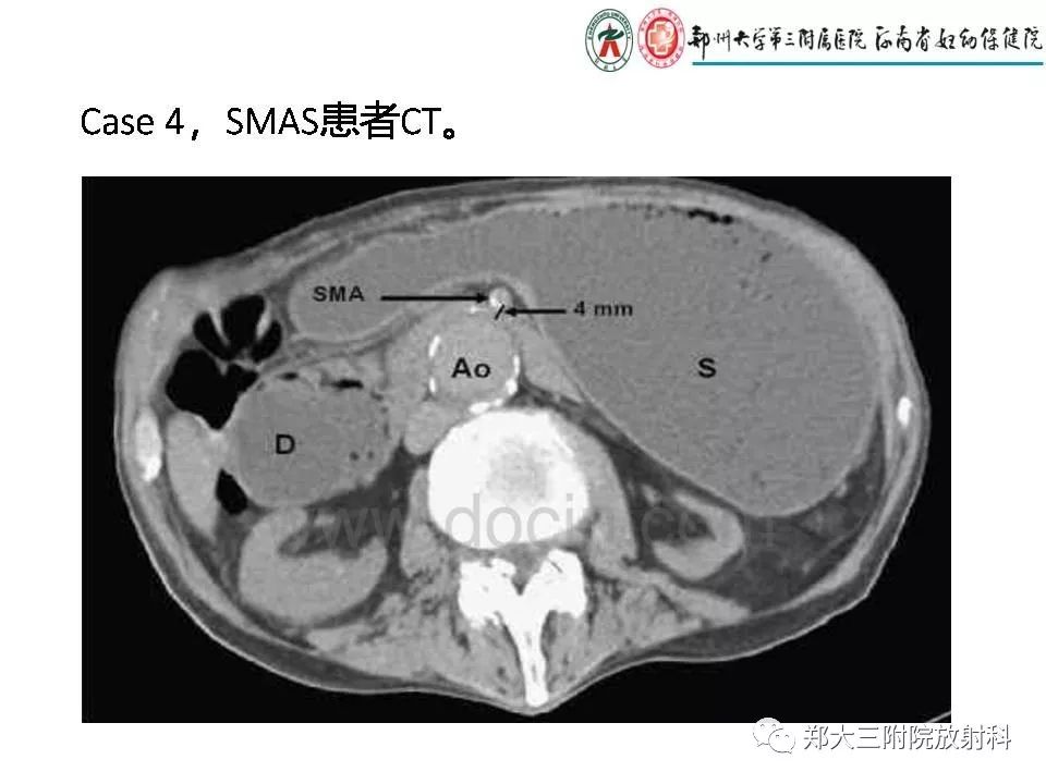 【PPT】肠系膜上动脉综合征​