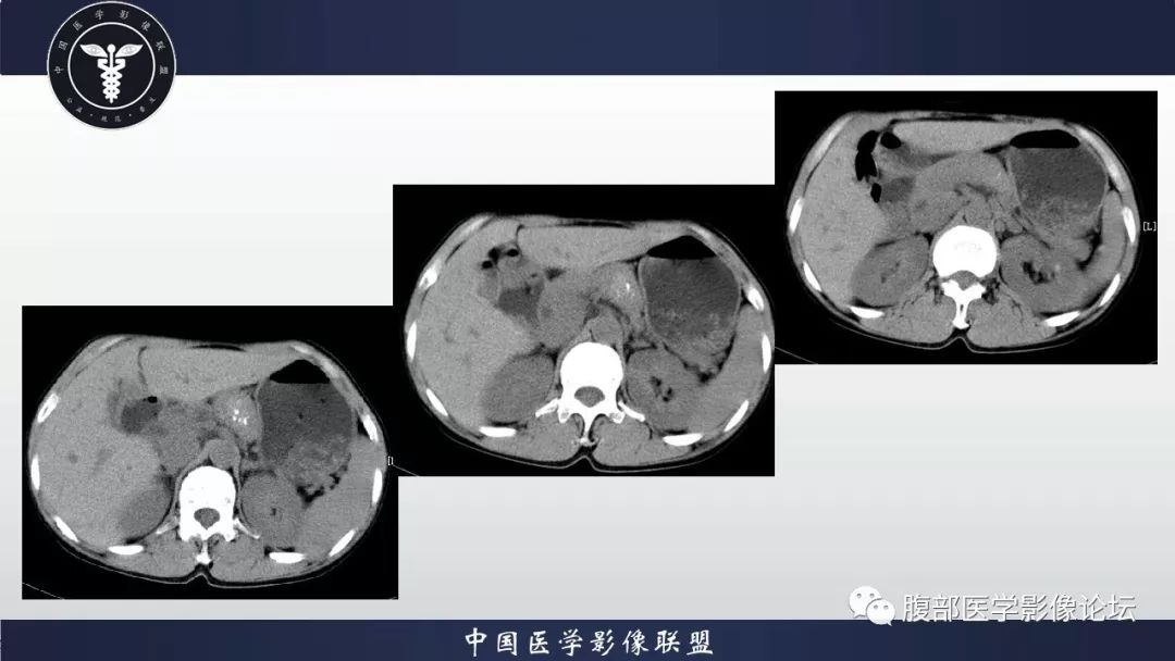 【病例】胰体尾部巨淋巴结增生症1例