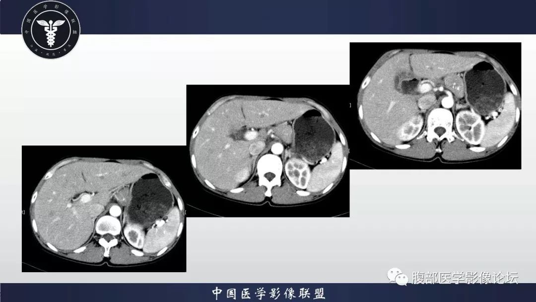 【病例】胰体尾部巨淋巴结增生症1例