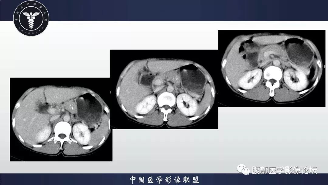 【病例】胰体尾部巨淋巴结增生症1例
