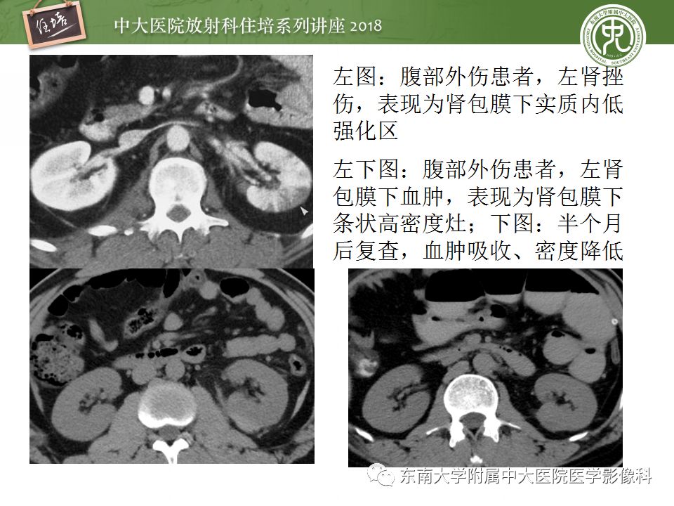 【PPT】腹膜后外伤的CT表现