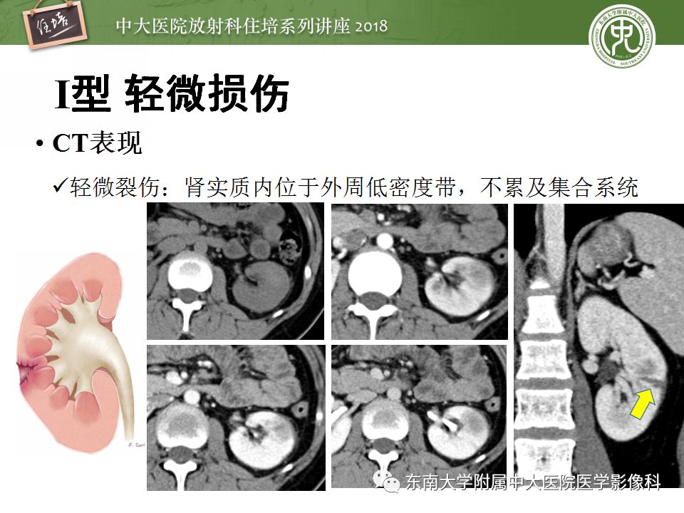 【PPT】腹膜后外伤的CT表现