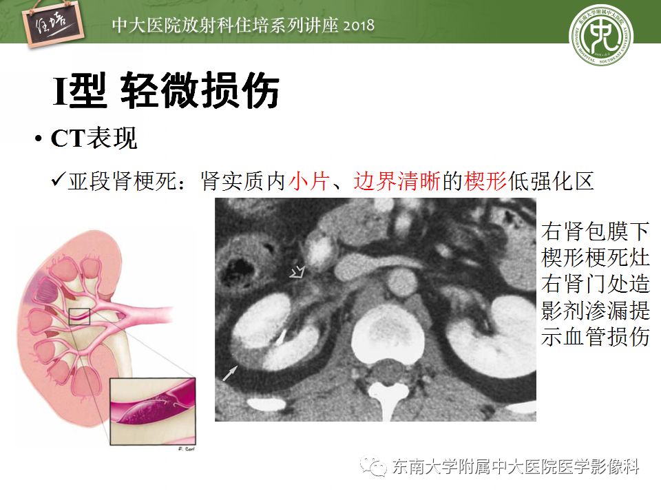 【PPT】腹膜后外伤的CT表现
