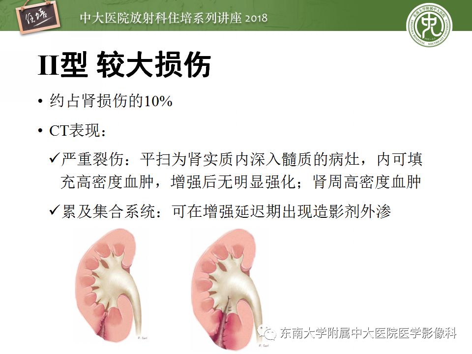 【PPT】腹膜后外伤的CT表现