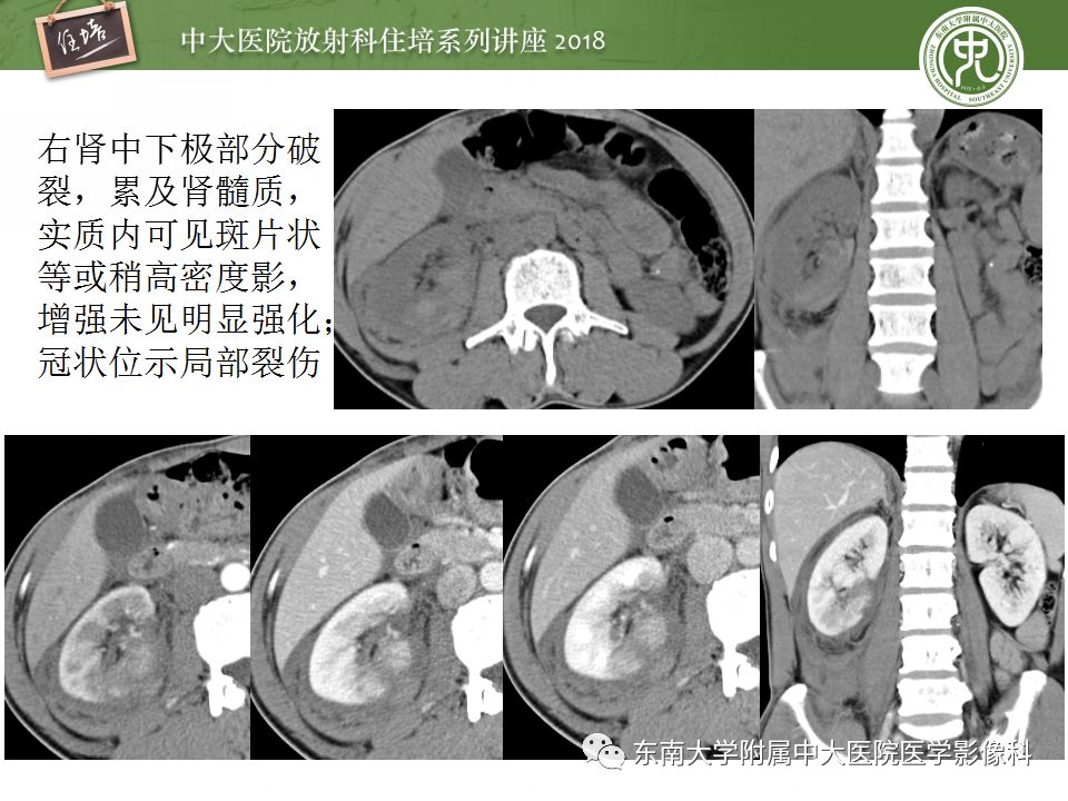 【PPT】腹膜后外伤的CT表现