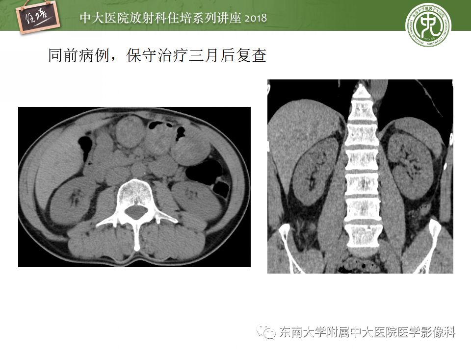 【PPT】腹膜后外伤的CT表现