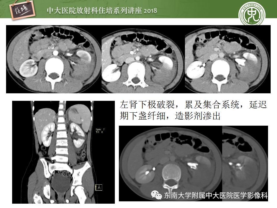 【PPT】腹膜后外伤的CT表现