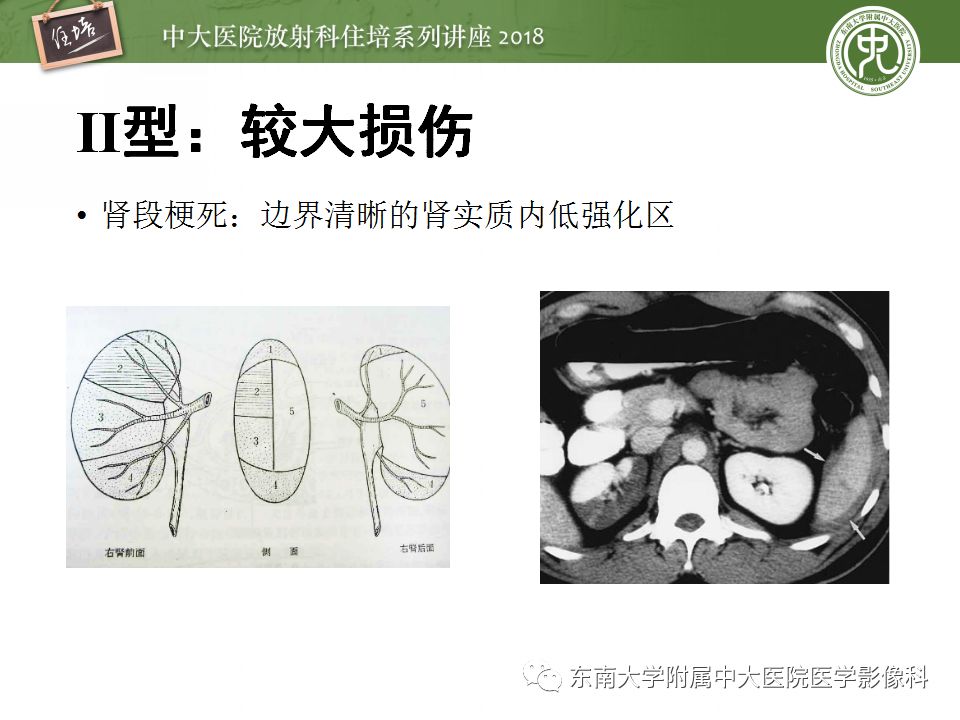 【PPT】腹膜后外伤的CT表现