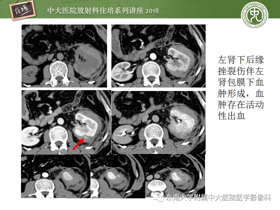 【PPT】腹膜后外伤的CT表现