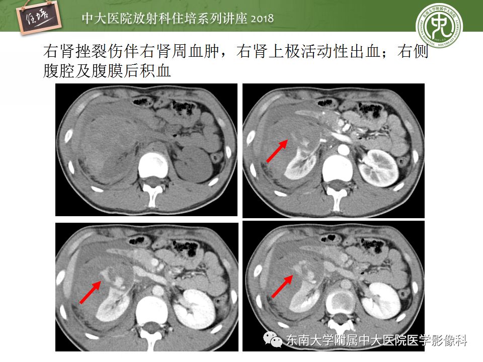 【PPT】腹膜后外伤的CT表现