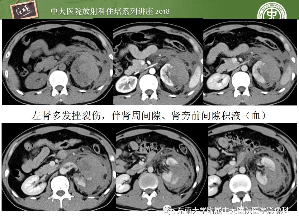【PPT】腹膜后外伤的CT表现
