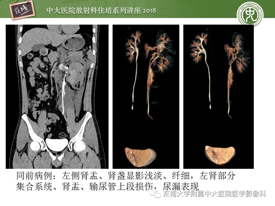 【PPT】腹膜后外伤的CT表现