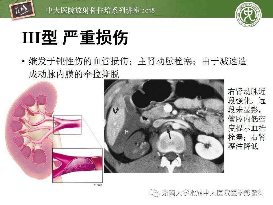 【PPT】腹膜后外伤的CT表现
