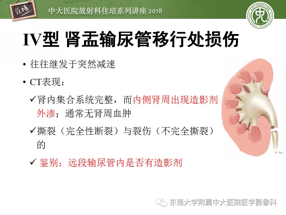 【PPT】腹膜后外伤的CT表现